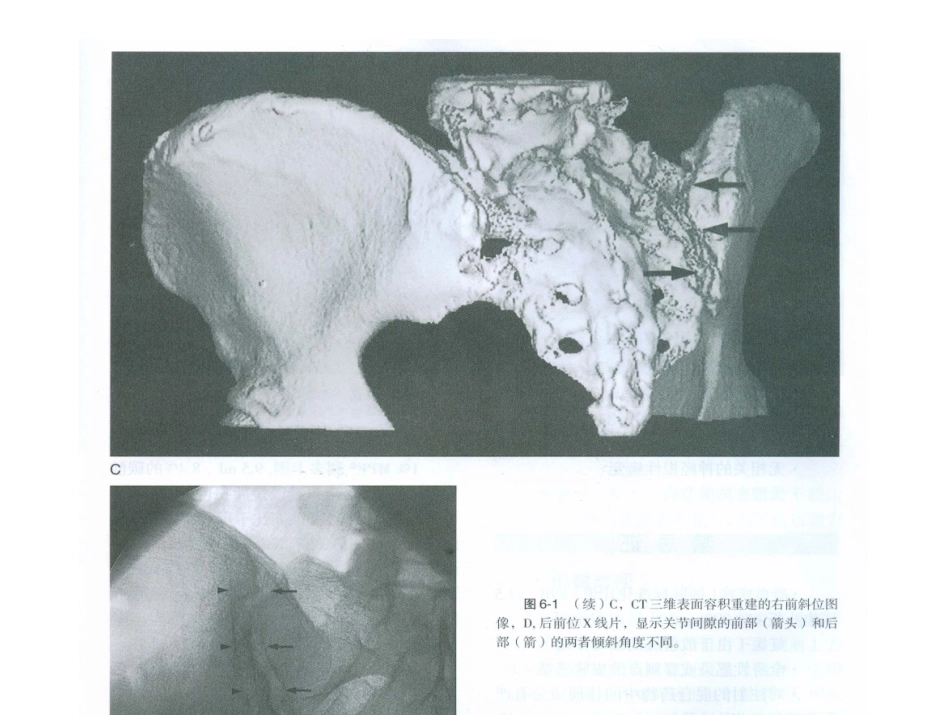 骶髂关节注射术_第2页