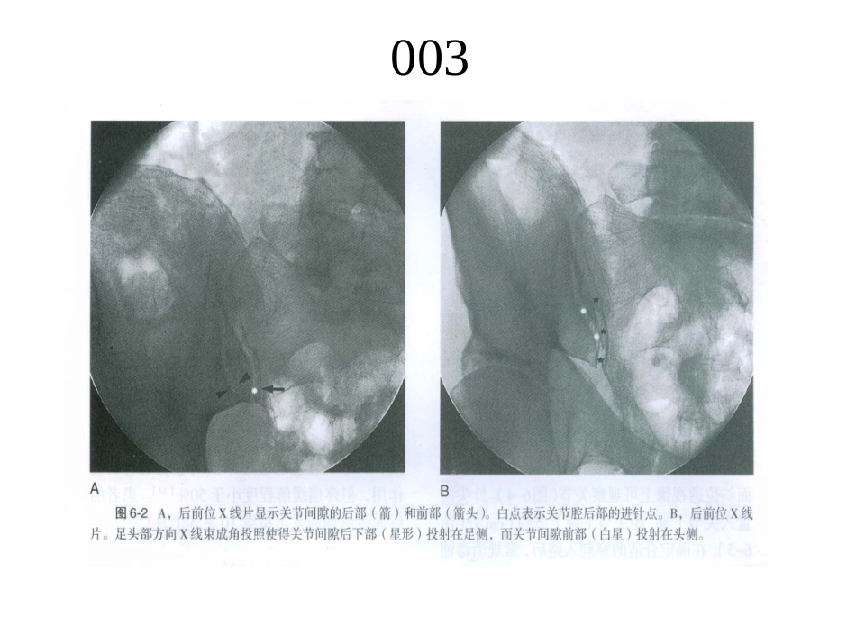 骶髂关节注射术_第3页