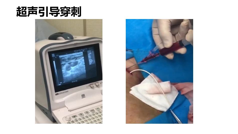 刁岩输液港植入体会及并发症处置_第2页