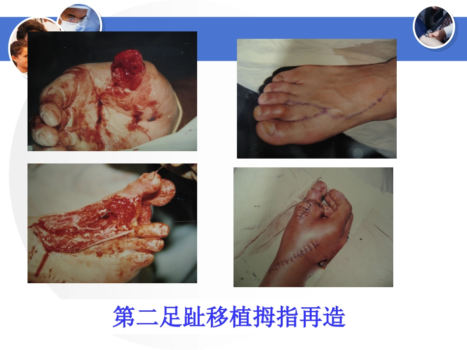 断指再植的护理体会_第3页