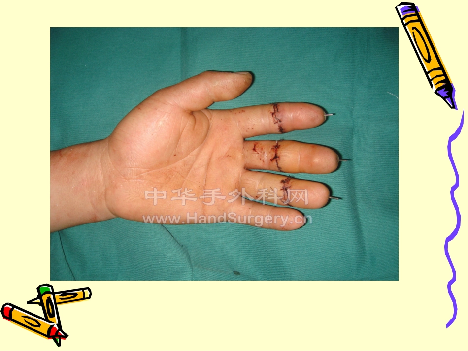 断指再植患者的护理_第3页
