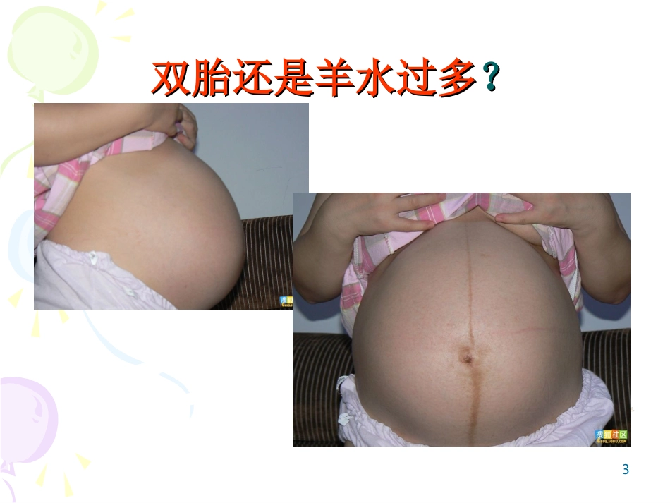 多胎妊娠幻灯片课件_第3页