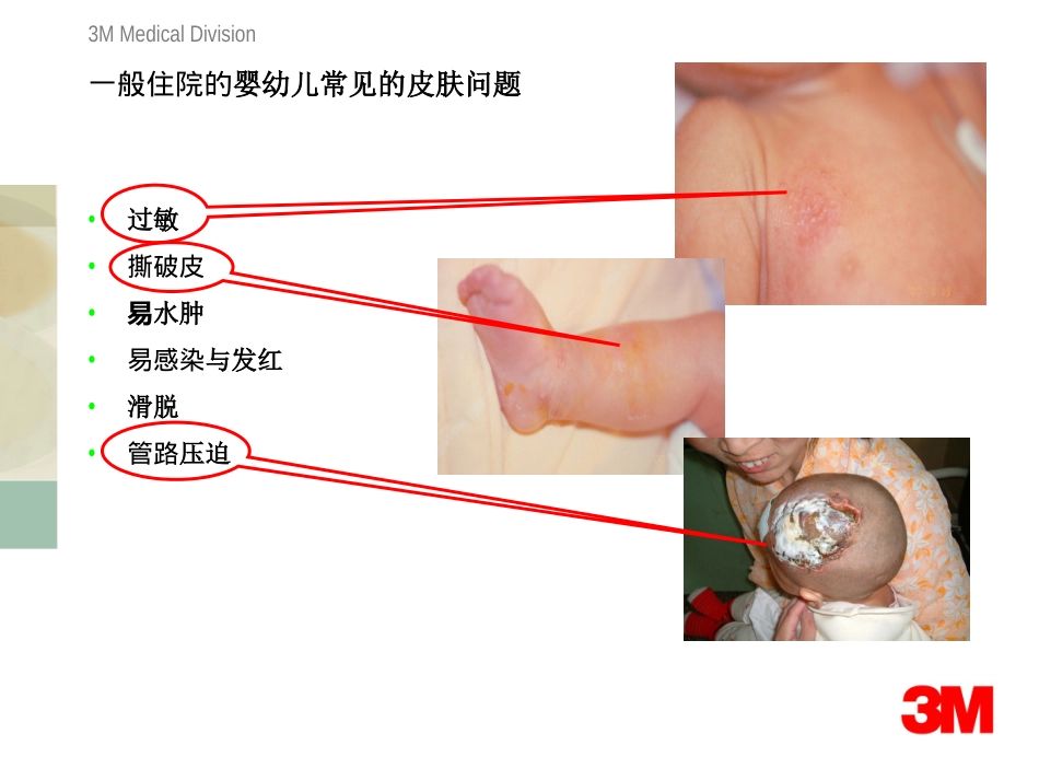 儿科常见导管的固定_第3页