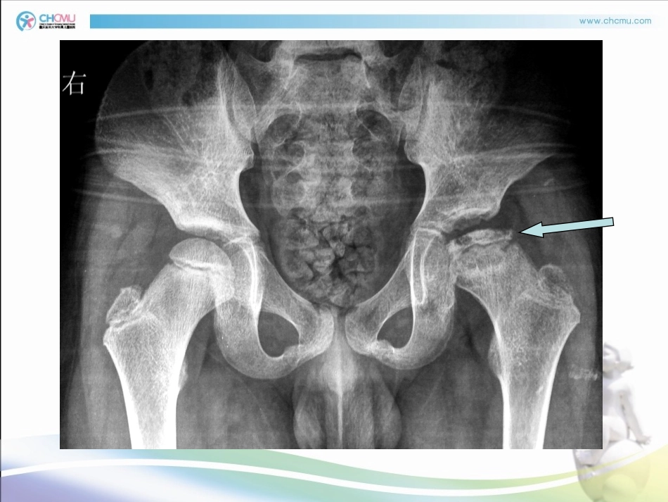 儿科学股骨头坏死_第3页