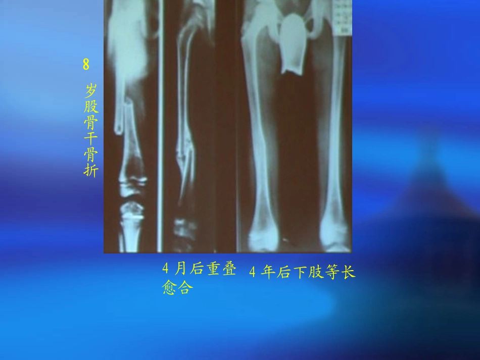 儿童股骨干骨折_第3页