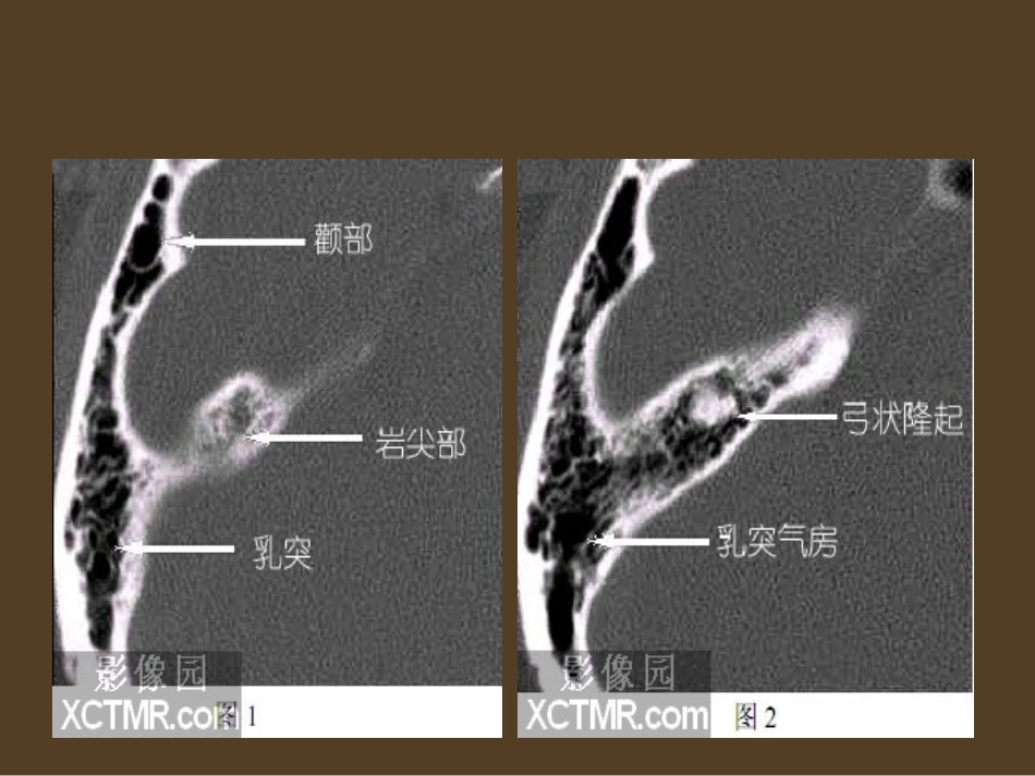 耳部最详细CT解剖_第2页