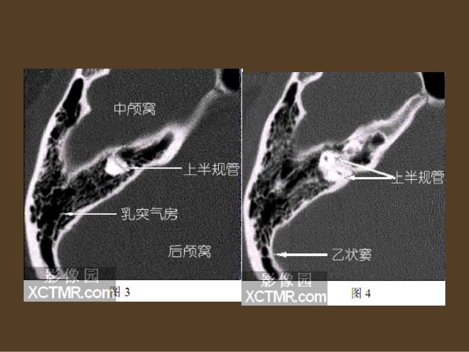 耳部最详细CT解剖_第3页