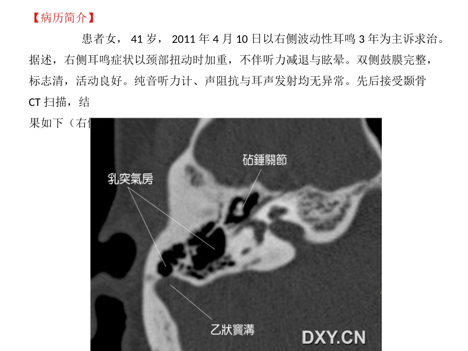 耳鸣和乙状窦憩室分解_第2页