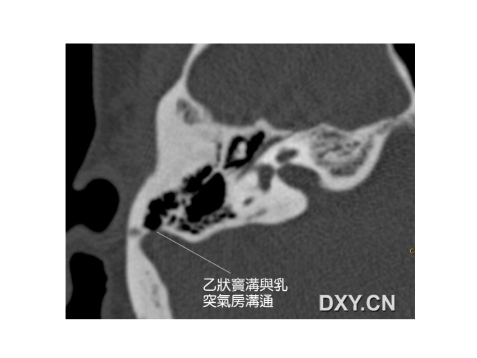 耳鸣和乙状窦憩室分解_第3页