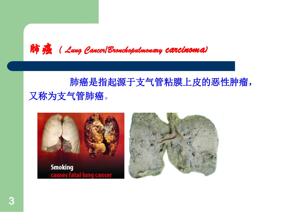 肺癌的早期诊疗和防治课件_第3页