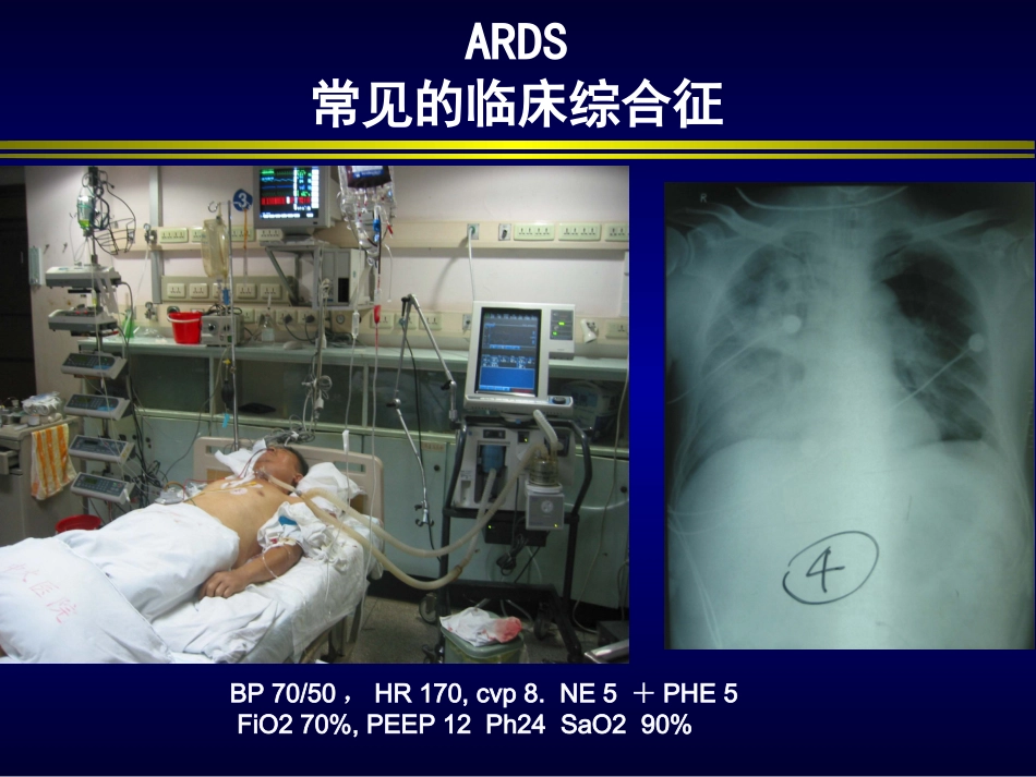 肺保护性通气_第2页