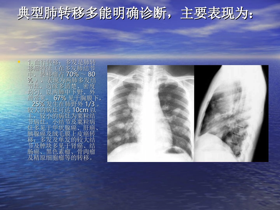 肺部转移瘤的影像诊疗_第2页