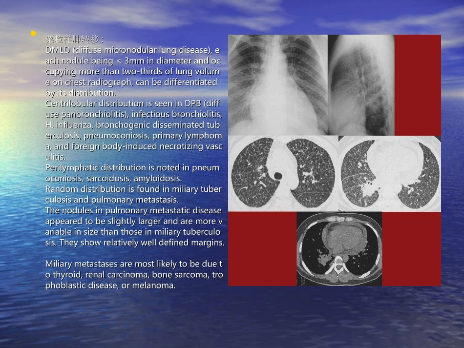 肺部转移瘤的影像诊疗_第3页
