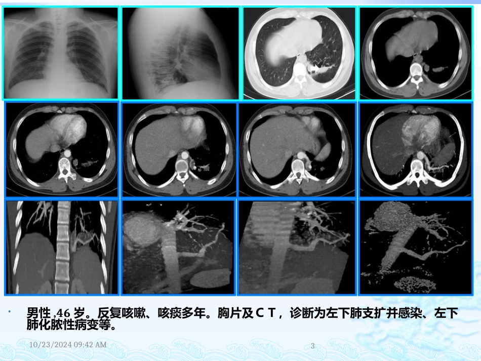 肺隔离症影像学诊疗_第3页