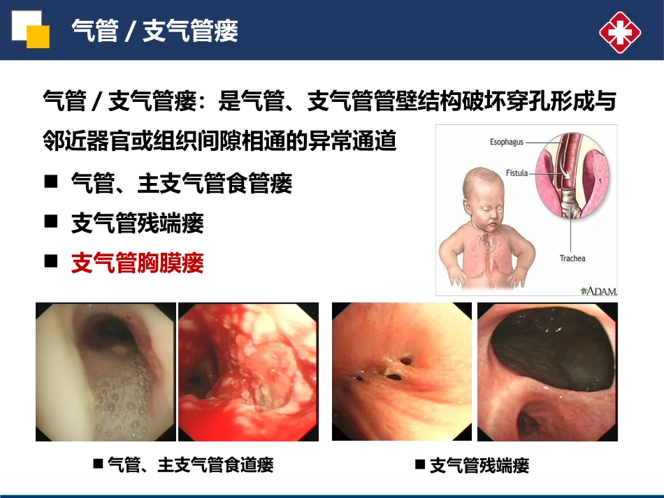 肺切除术后支气管胸膜瘘的处置策略_第3页