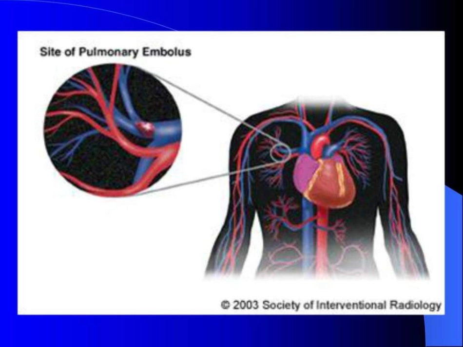 肺栓塞护理查房_第3页