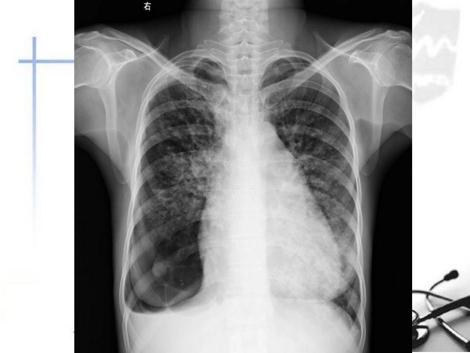 肺水肿的线表现_第3页