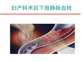 妇产科术后下肢静脉血栓