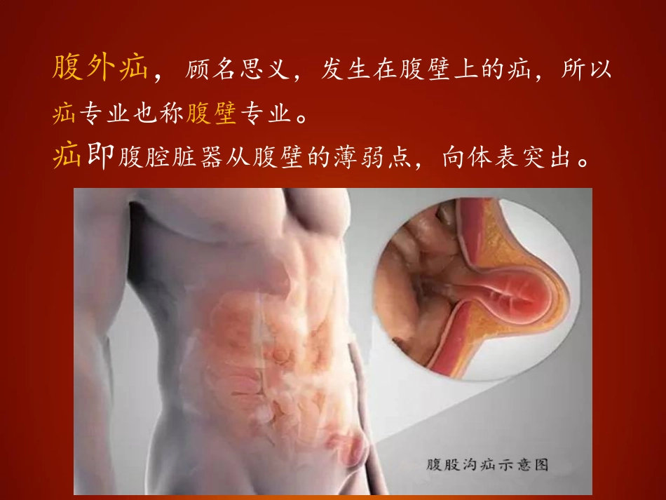 腹股沟疝的规范化治疗_第2页