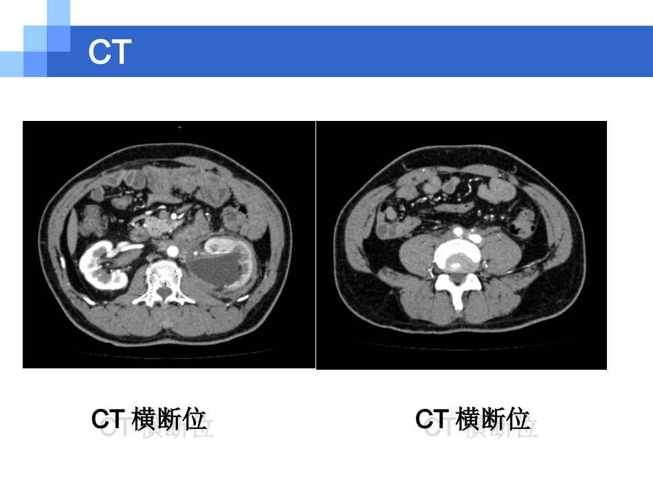腹膜后纤维化资料_第2页