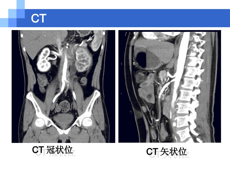 腹膜后纤维化资料_第3页