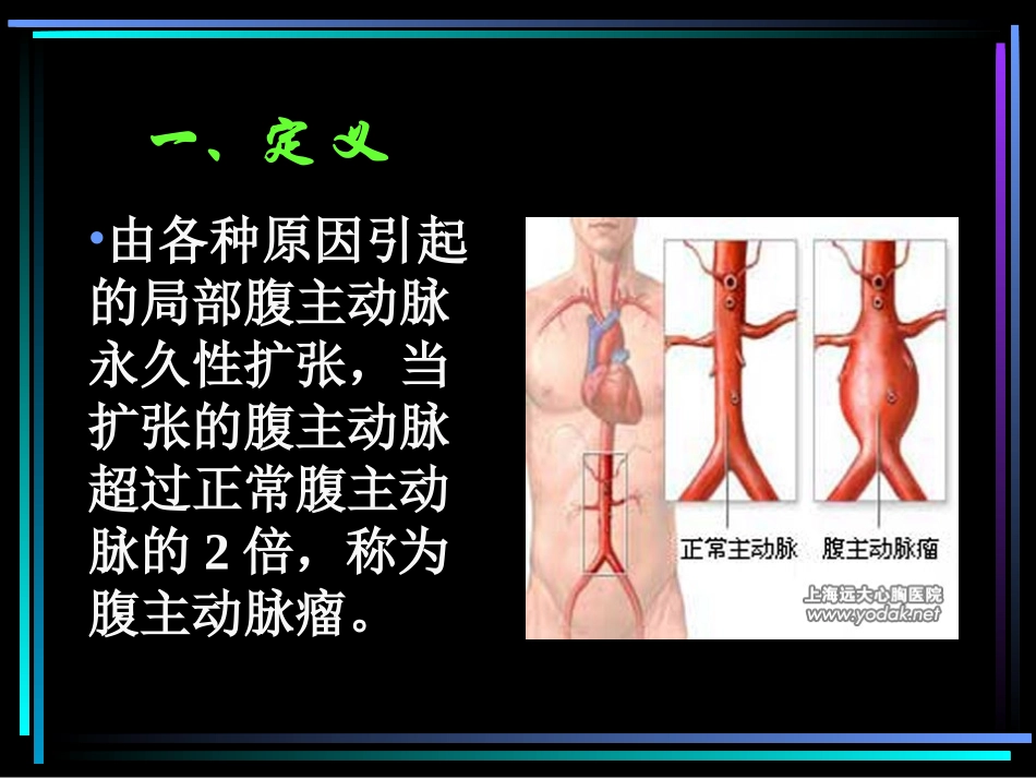 腹主动脉瘤课件_第2页