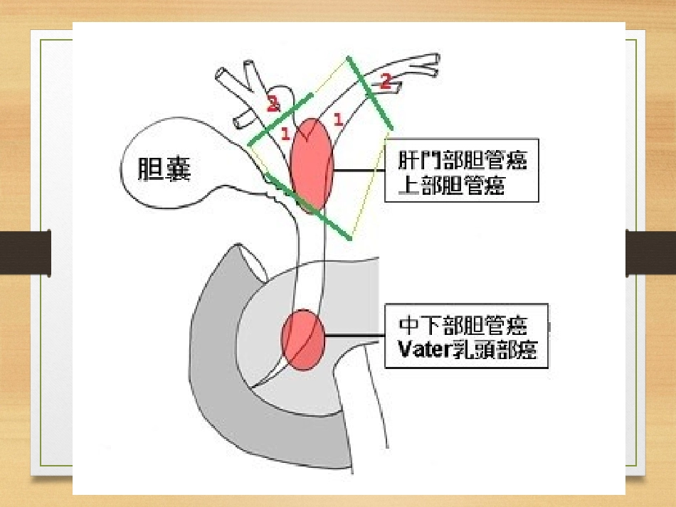 肝门部胆管癌医学_第3页