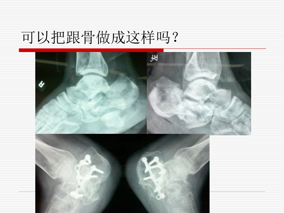 跟骨手术治疗技巧_第2页