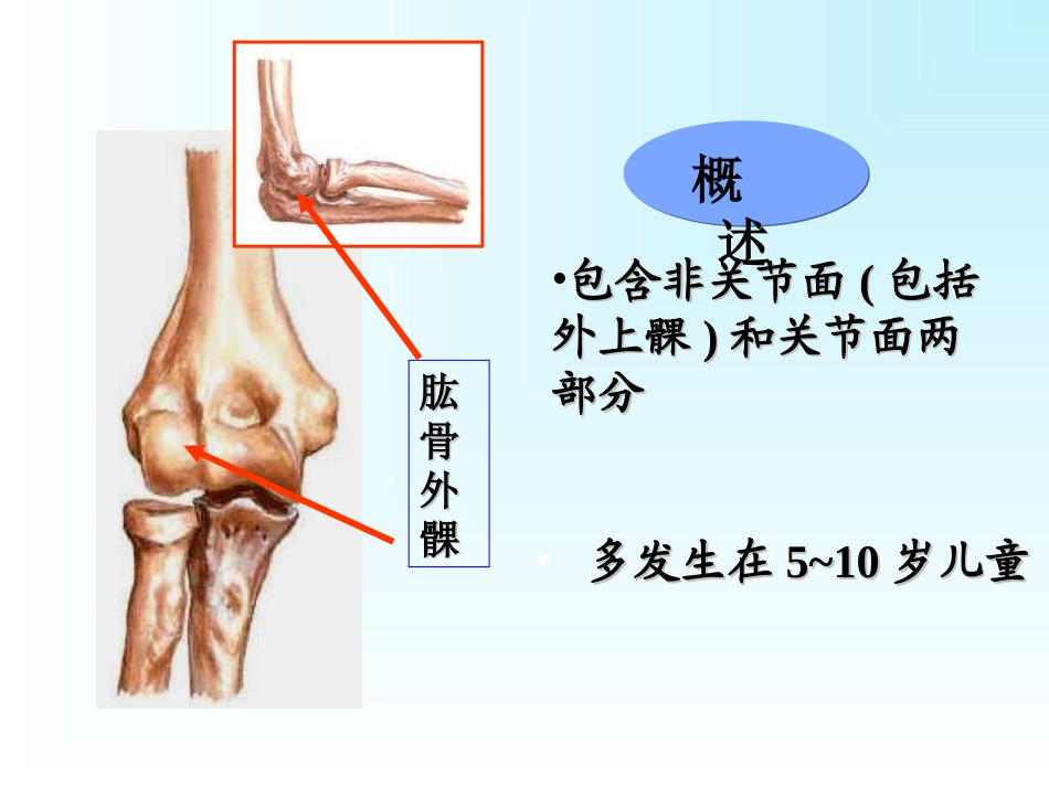 肱骨外髁骨折肱骨内上髁骨折尺骨鹰嘴骨折_第3页
