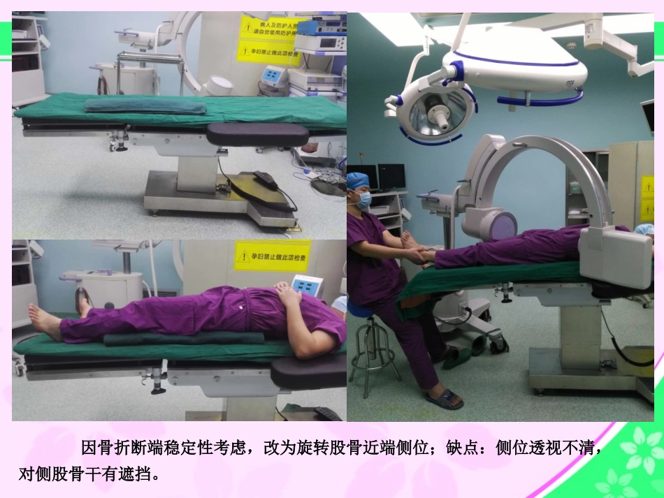 股骨近端骨折的几个感悟好_第3页