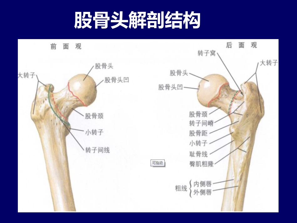 股骨头坏死简介_第3页