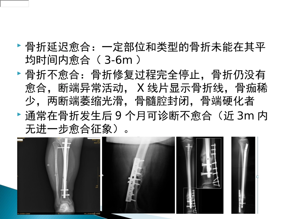 骨不愈合的诊疗和治疗_第2页