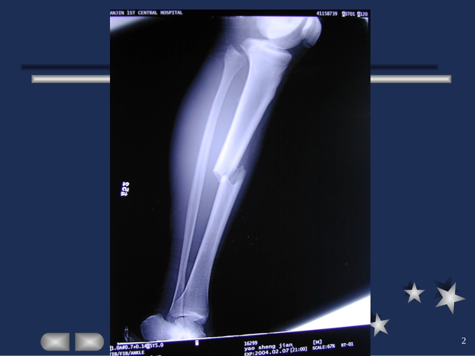 骨科创伤课件_第2页