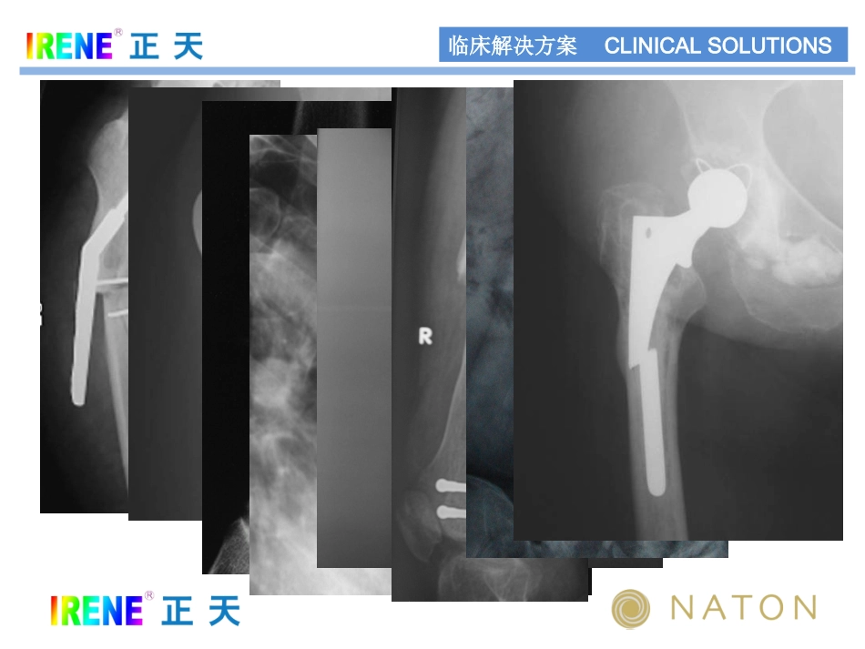 骨科医生的难题内固定断裂_第2页