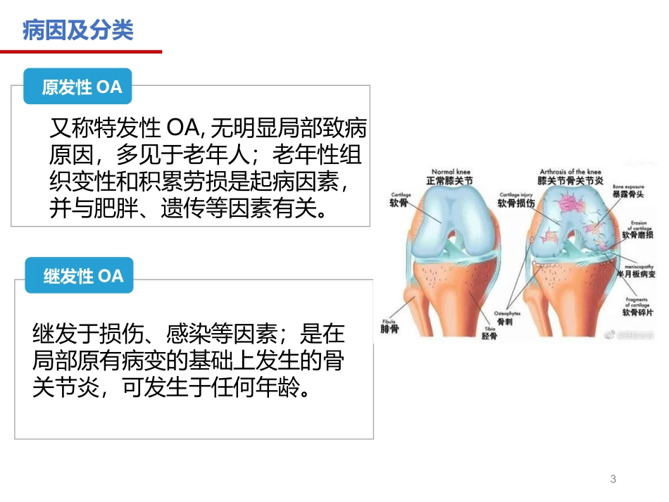 骨性关节炎的康复_第3页