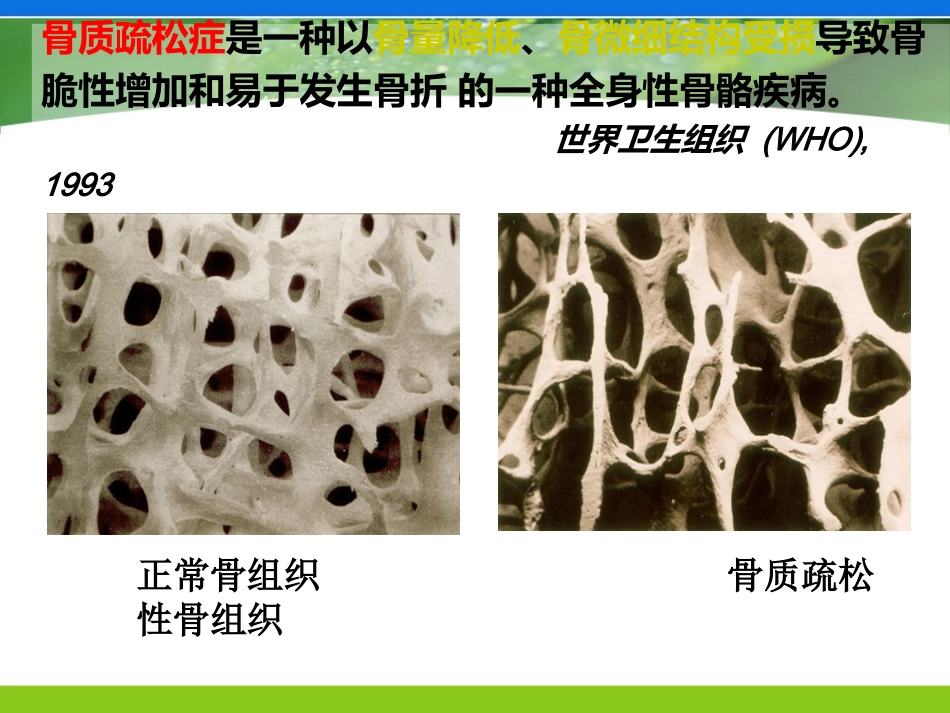 骨质疏松症的护理_第3页