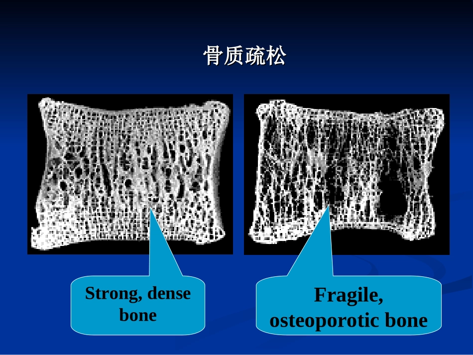 骨质疏松症预防和治疗_第3页