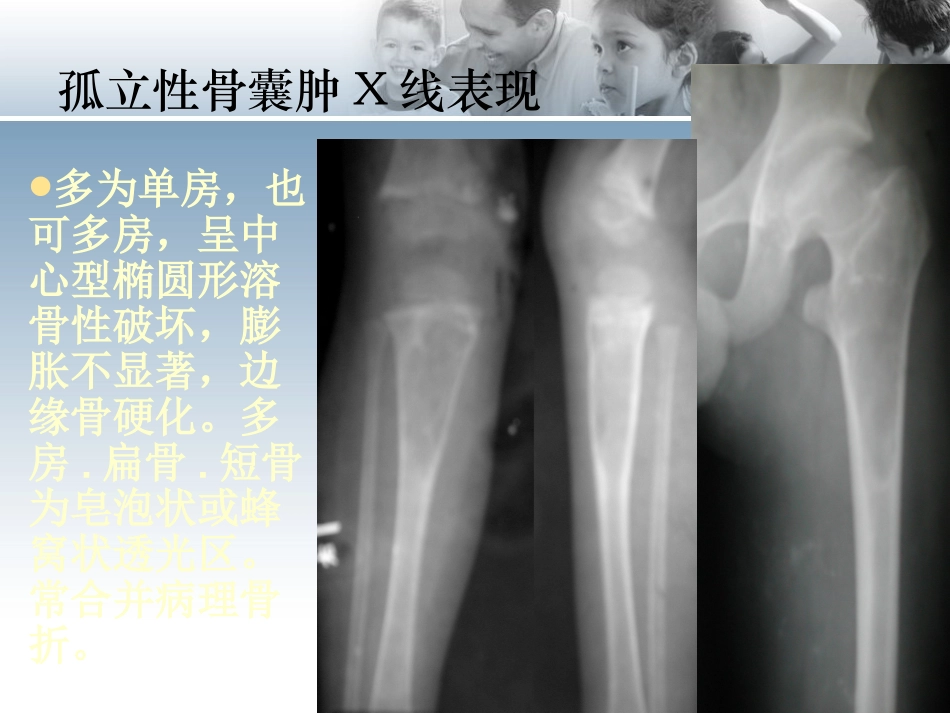 骨肿瘤样病变影像诊疗_第3页