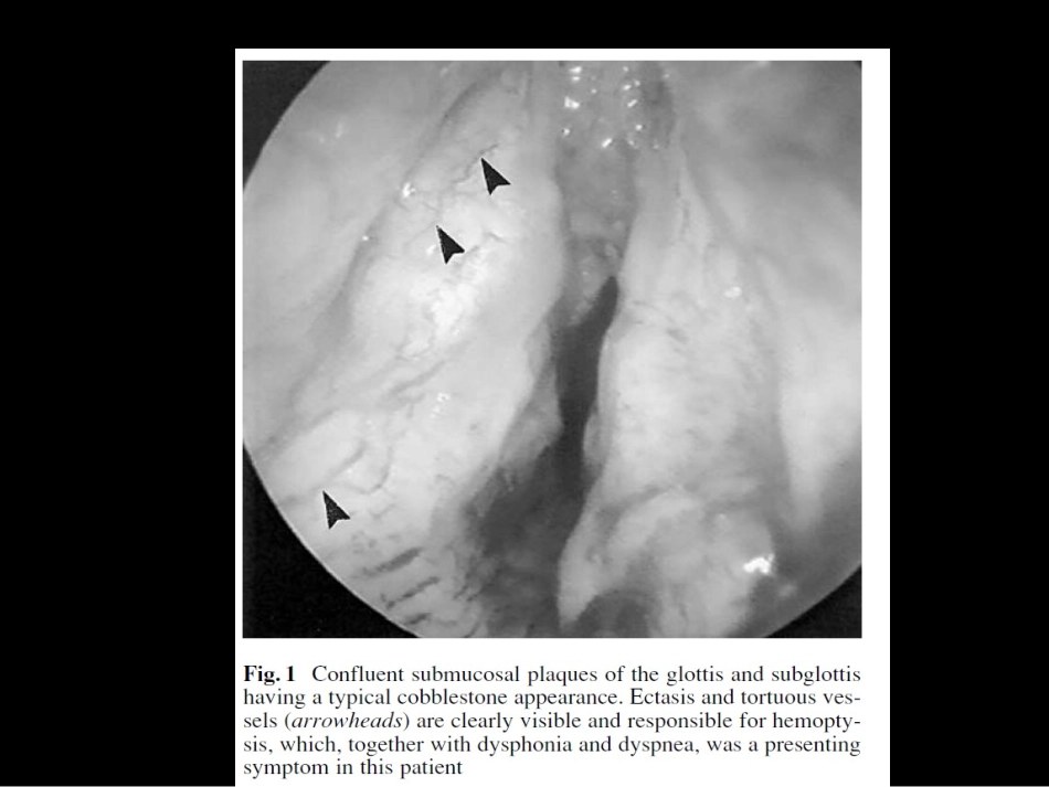 喉气管支气管淀粉样变_第3页