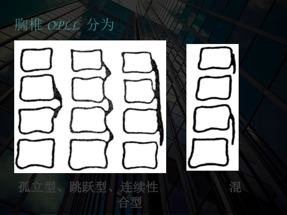 后纵韧带钙化_第2页