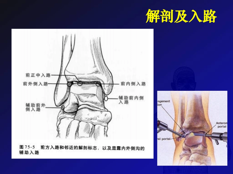 踝关节镜技术在治疗踝关节疾病中的应用课件_第3页