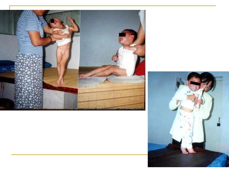 肌张力及评定_第2页