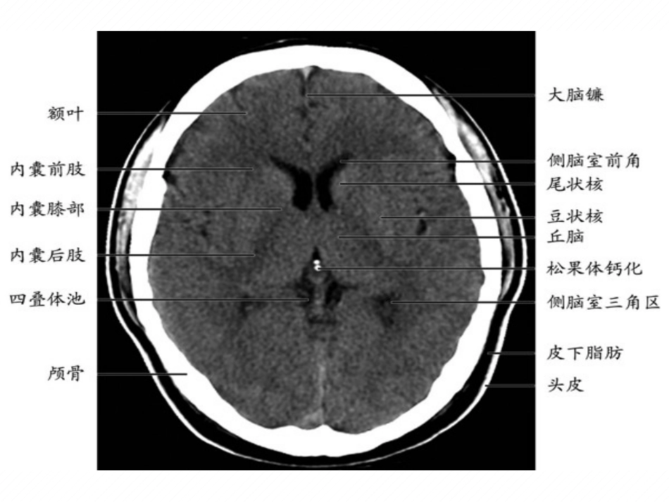 基底节区对称性病变的病因和影像学特征_第3页