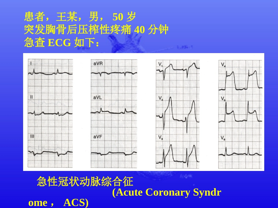 急性冠状动脉综合征_第2页