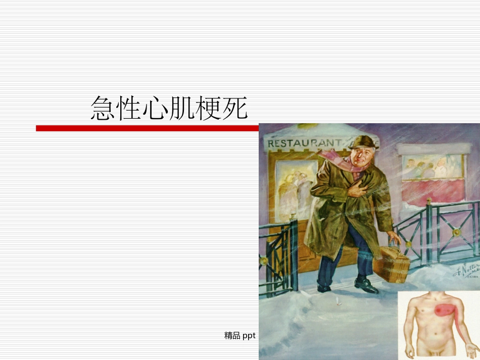 急性心肌梗死医学课件_第1页