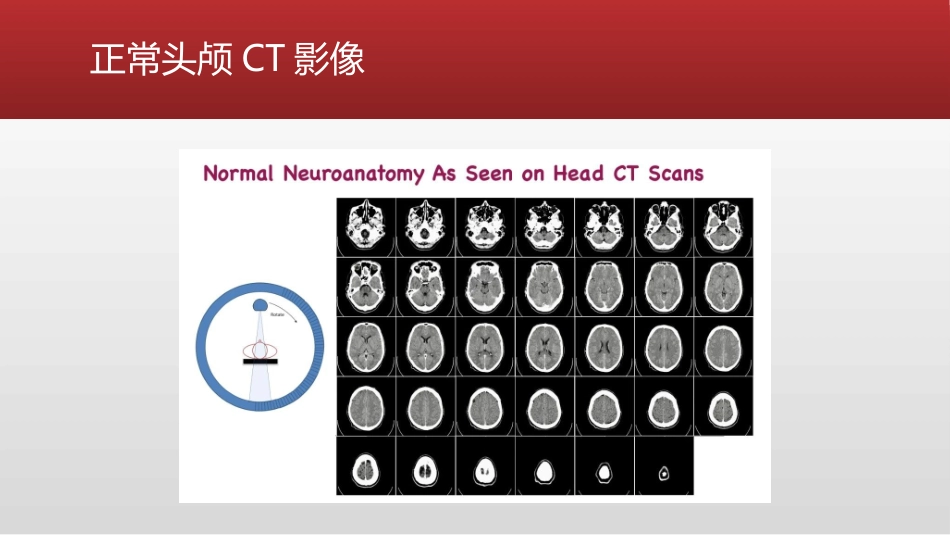 急诊头颅CT阅读法_第3页