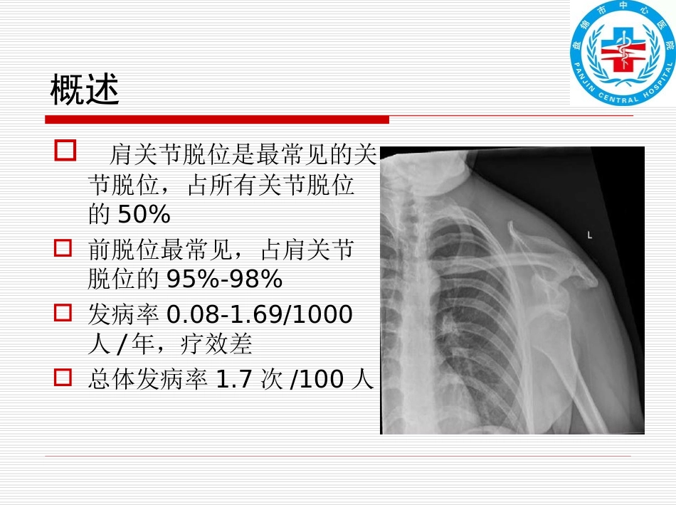 肩关节骨折脱位_第2页