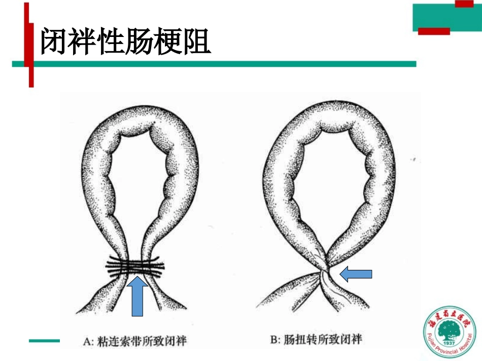 绞窄性肠梗阻影像诊疗_第3页