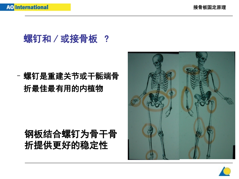 接骨板固定原理_第2页