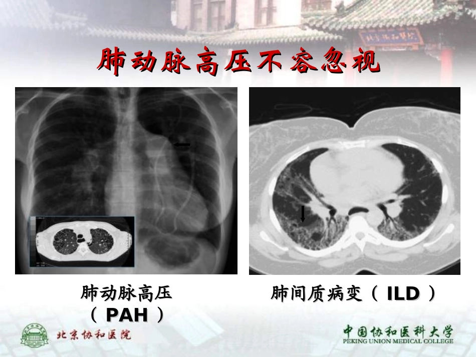 结缔组织病相关肺动脉高压李梦涛课件_第3页